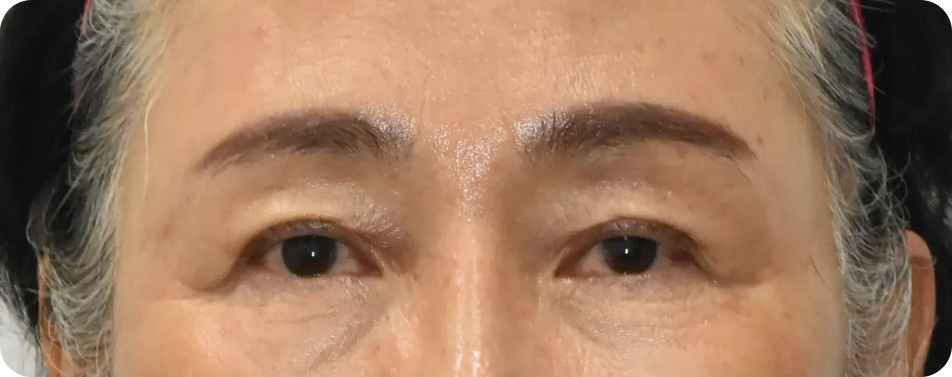 After endoscopic brow lift - lifting sagging brows and smoothening glabellar lines