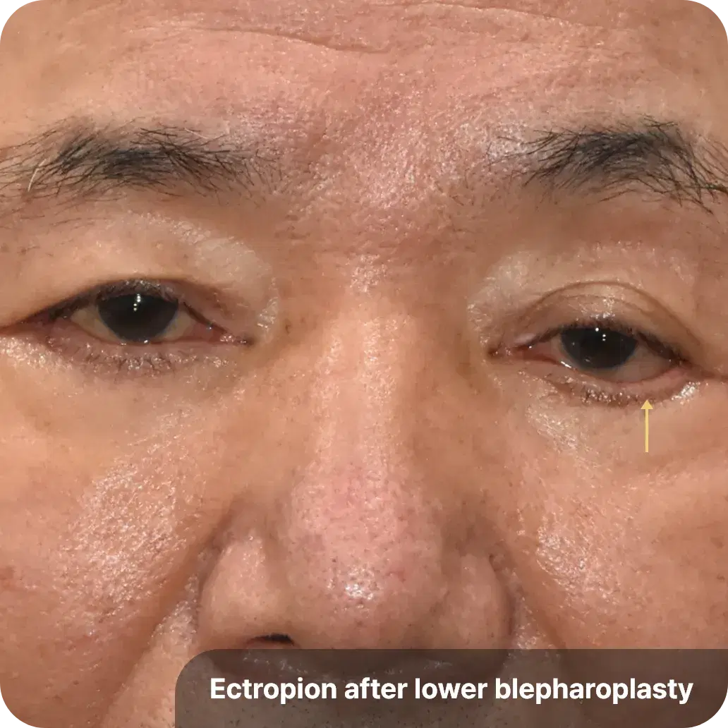 lower eyelid surgery complication - ectropion