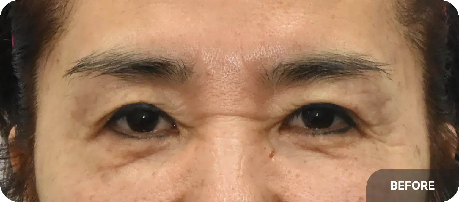 severe glabellar wrinkle - before brow lift and lower blepharoplasty