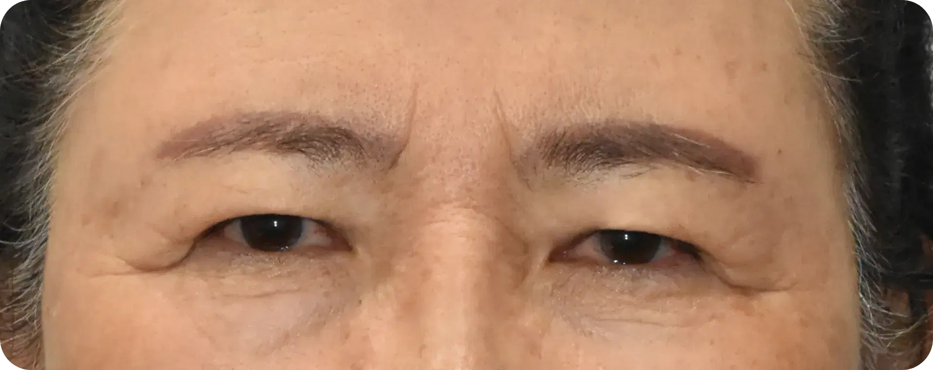 눈썹과 눈 거리가 좁고 미간주름이 발달한 경우 - 이마거상으로 만족하는 조건