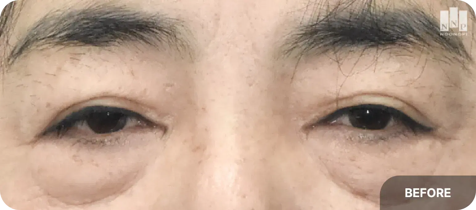 60대 여성의 심한 눈가 처짐 - 눈썹하거상, 눈매 교정, 하안검 성형이 필요한 사례