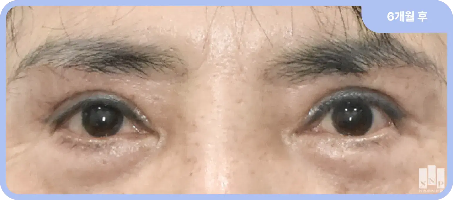 눈 주위 처짐 개선 후 60대 여성 - 커진 눈동자와 젊어보이는 눈매