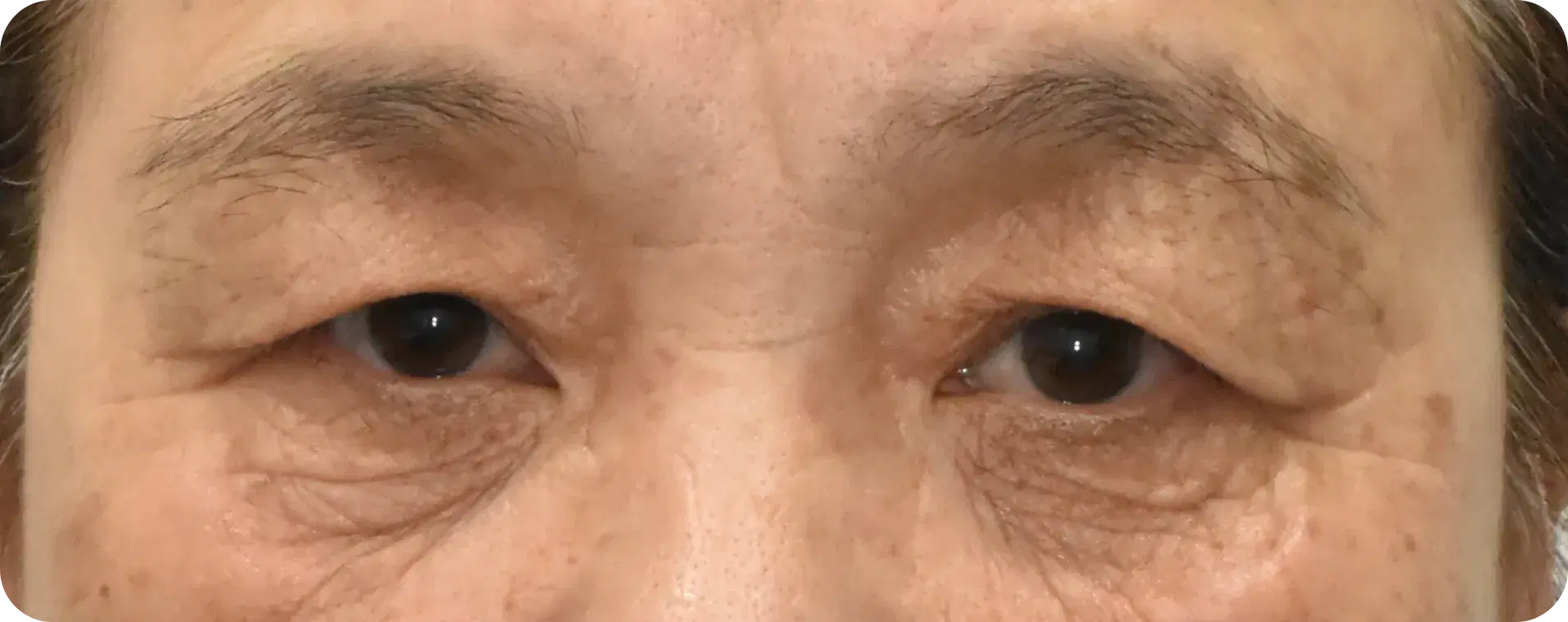 쌍꺼풀이 보이지 않을 정도로 처진 눈꺼풀과 깊은 눈 밑 주름