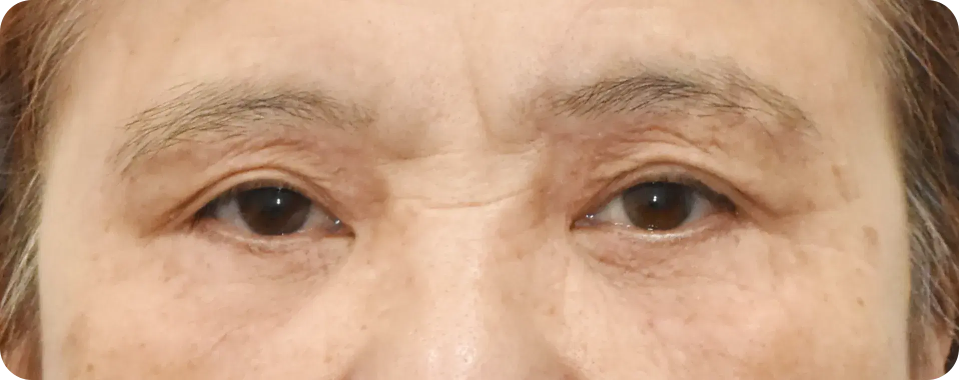 눈높이성형외과에서 눈썹하거상과 하안검 3개월 후 한층 젊고 생기있는 모습