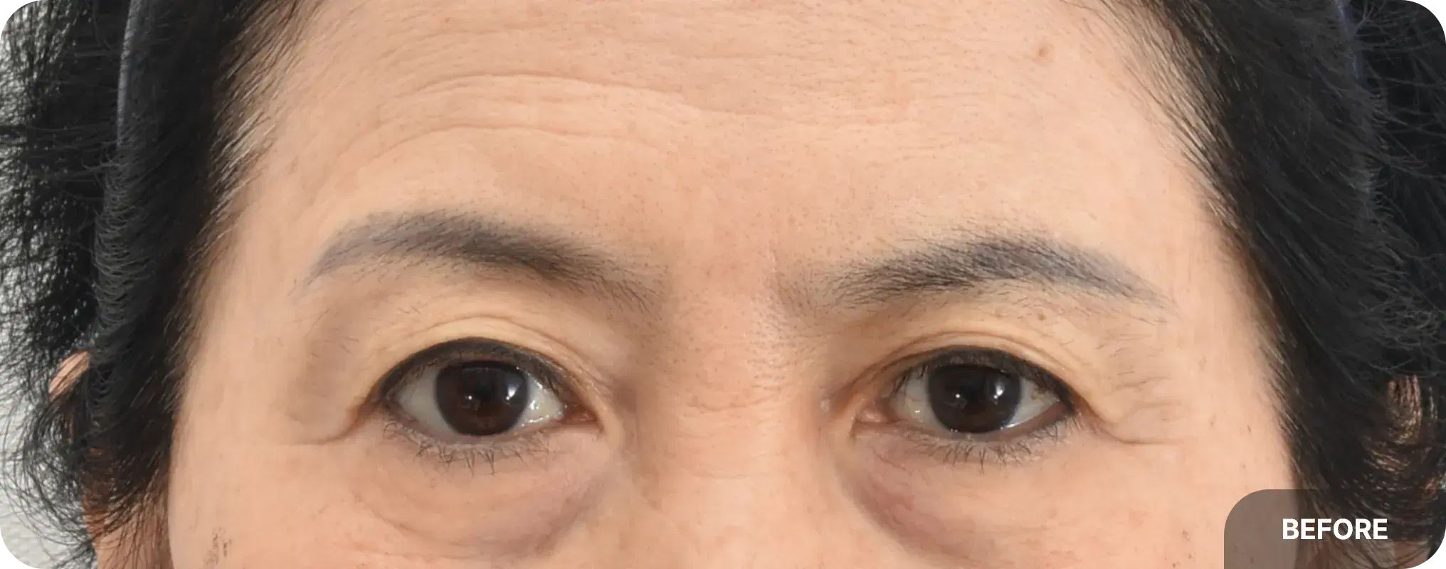 Post-endoscopic forehead lift with upper lid fat graft - refreshed appearance with lifted brows and reduced wrinkles