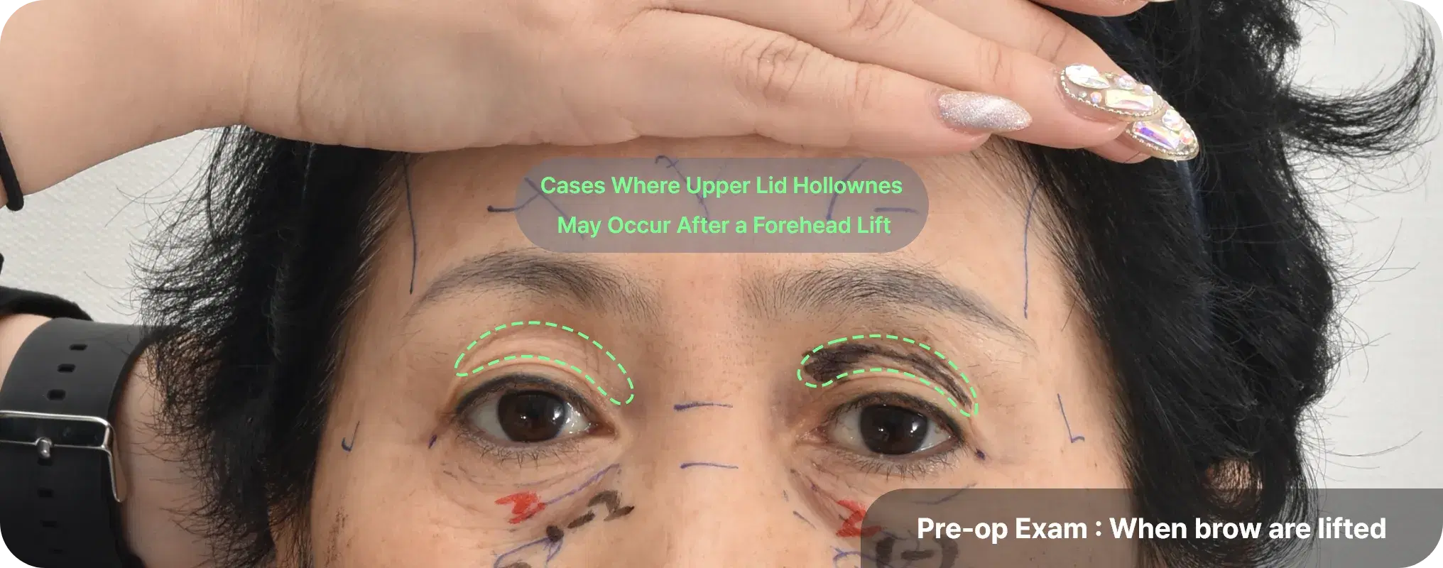Post-endoscopic forehead lift with upper lid fat graft - refreshed appearance with lifted brows and reduced wrinkles