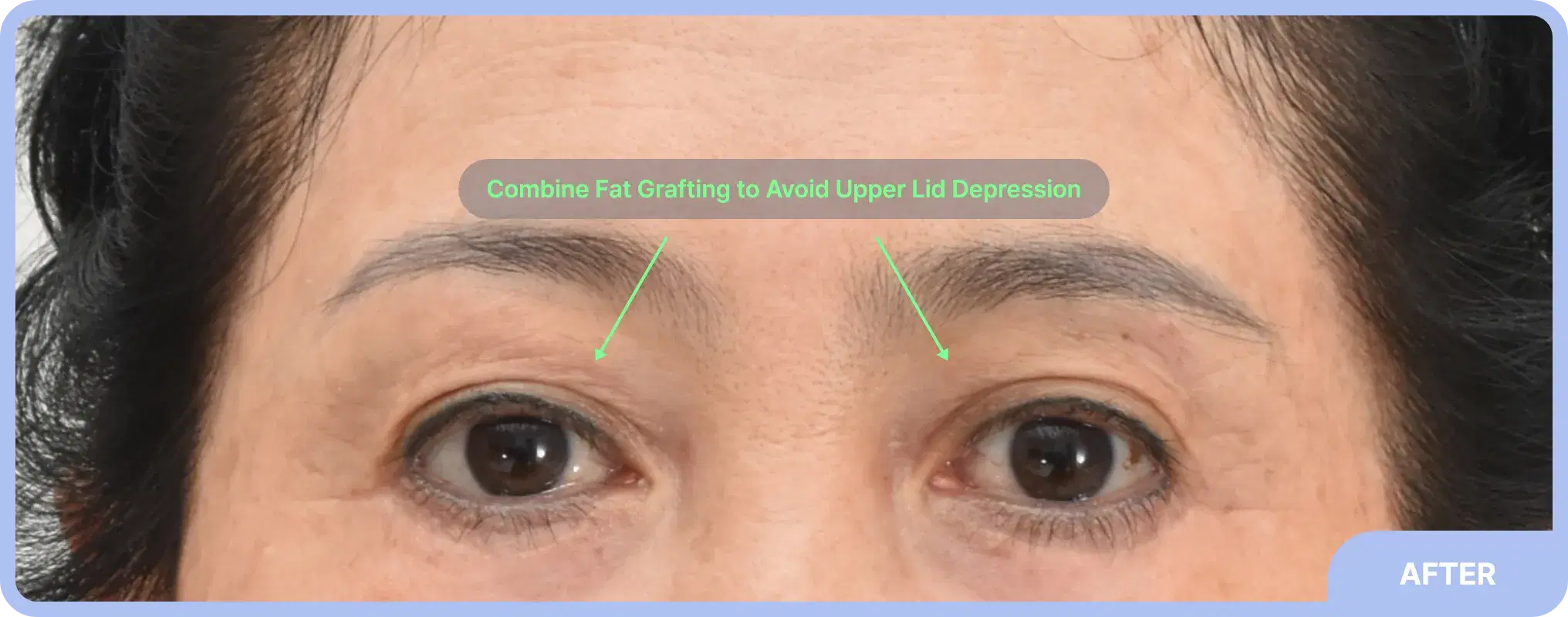 Post-endoscopic forehead lift with upper lid fat graft - refreshed appearance with lifted brows and reduced wrinkles