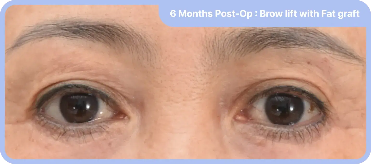 Endoscopic forehead lift - rejuvenating the upper face with minimal downtime