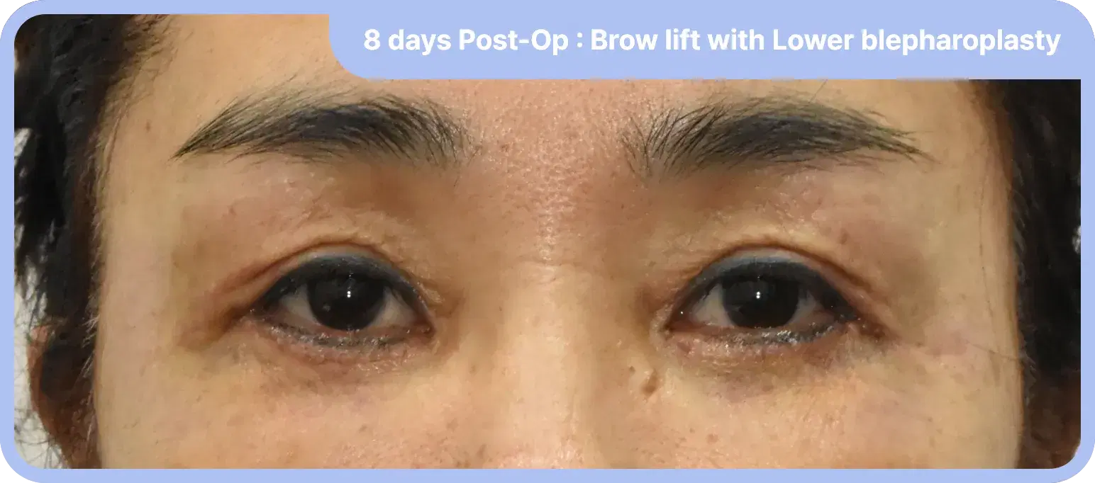 Frown lines treated after forehead lift and lower lid lift - achieving upper and lower periorbital rejuvenation
