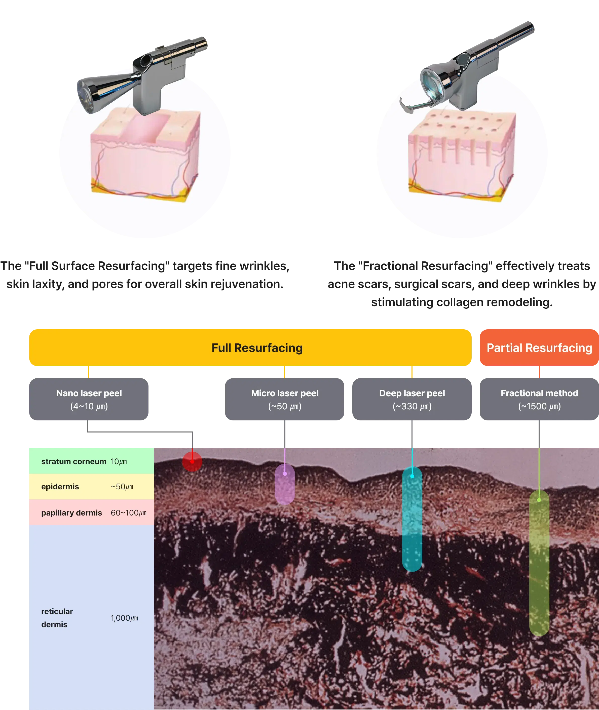 Sciton ZoomScan - full face facial resurfacing treatment/Sciton Profractional - fractional resurfacing laser/laser peeling with Sciton