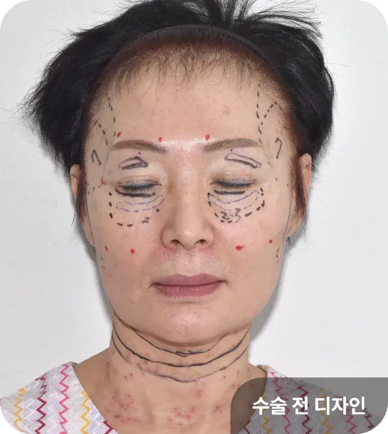 나노지방이식