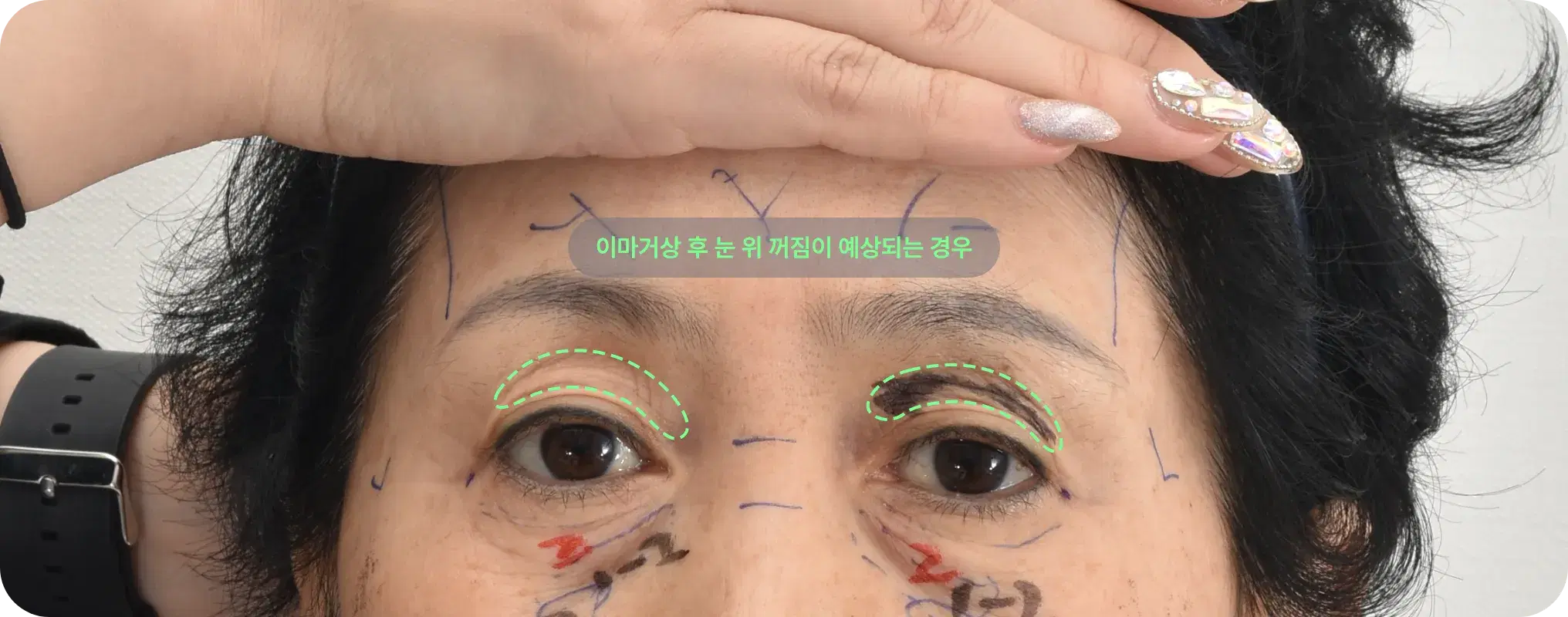 이마거상과 눈 위 아이홀 지방이식이 필요한 경우 - 처진 눈썹과 꺼진 눈 위 개선