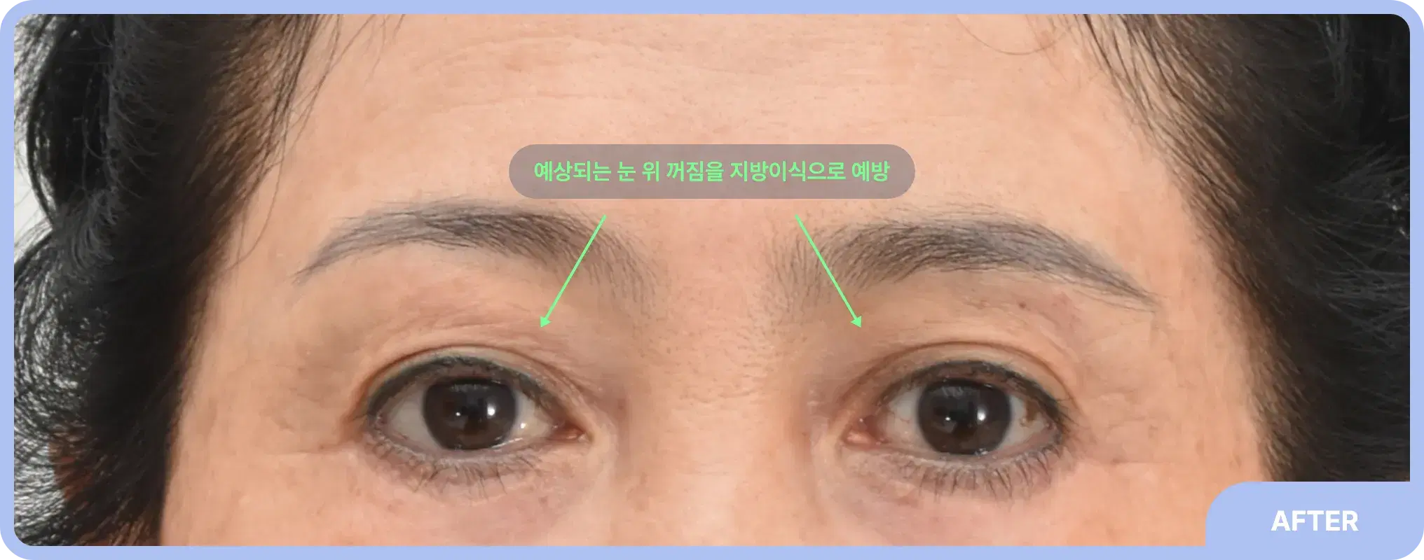 이마거상과 눈 위 아이홀 지방이식이 필요한 경우 - 처진 눈썹과 꺼진 눈 위 개선