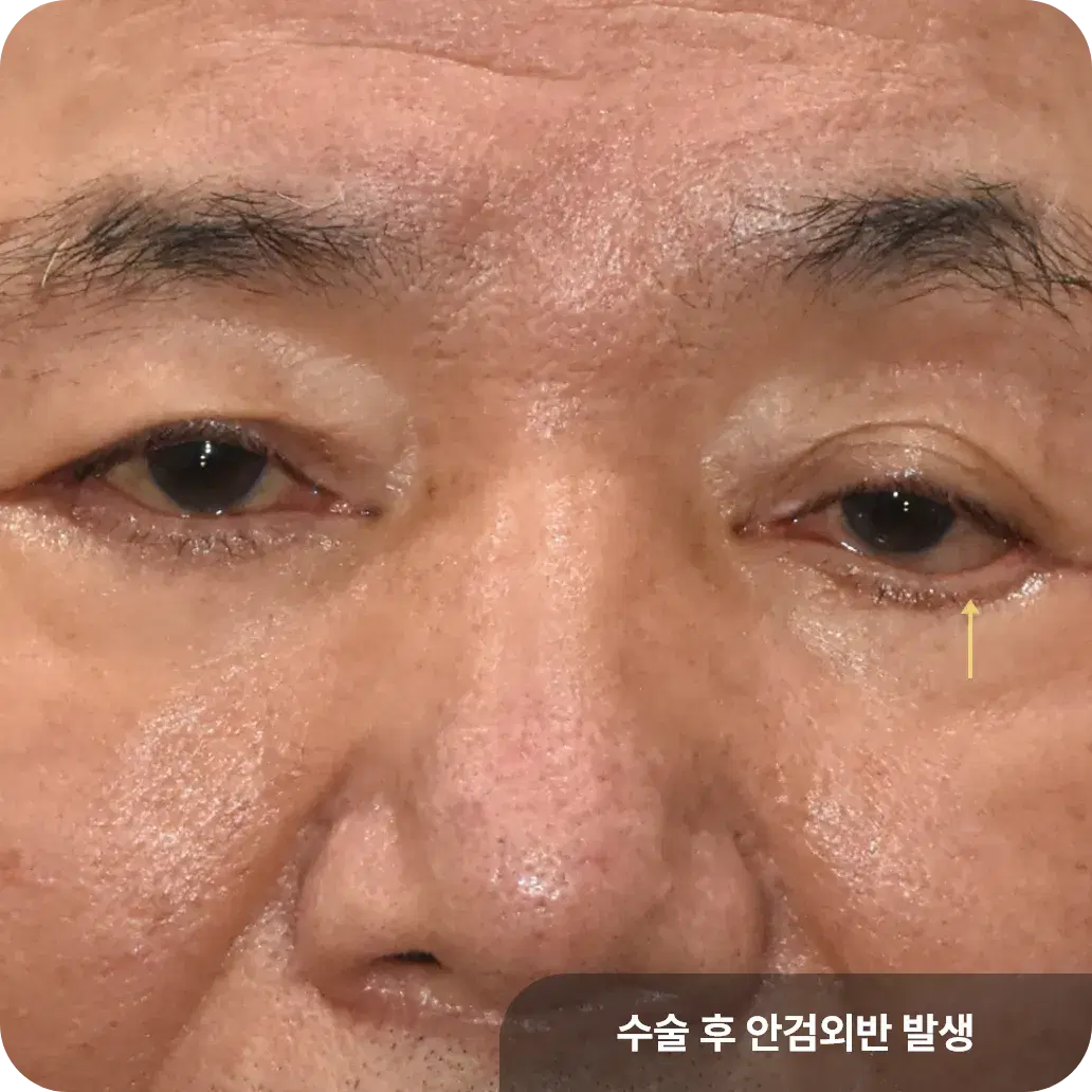 하안검성형 합병증으로 한쪽 눈꺼풀 뒤집어짐이 발생