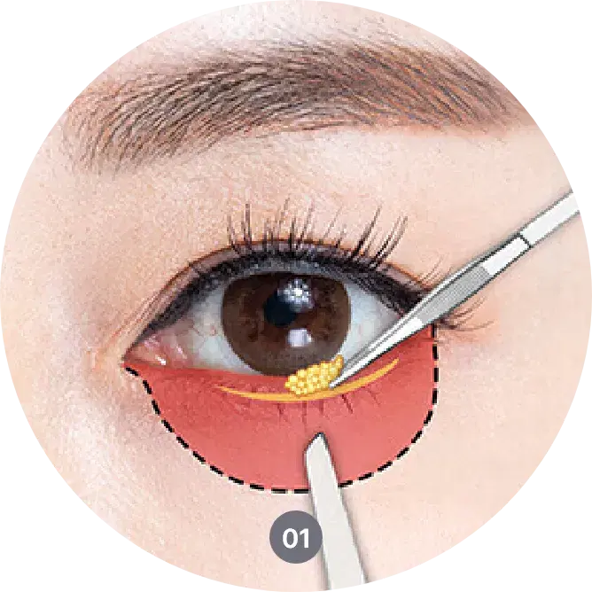 procedures of scar free lower blepharoplasty in korea