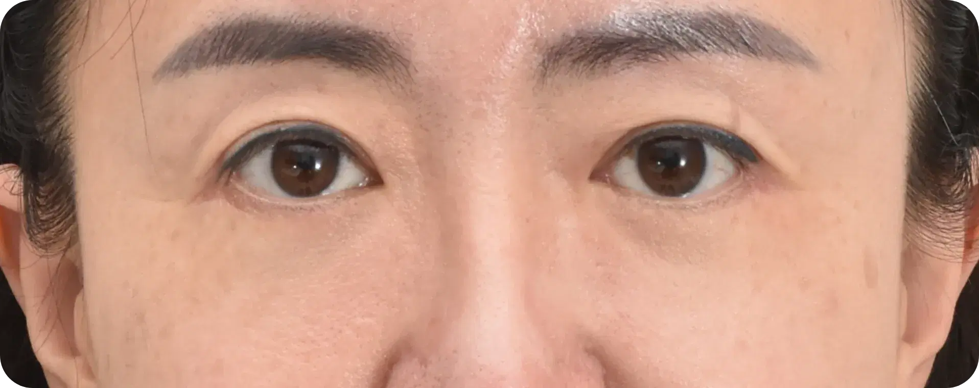 상안검 수술 후 젊어진 눈매 - 처진 눈꺼풀 개선 효과