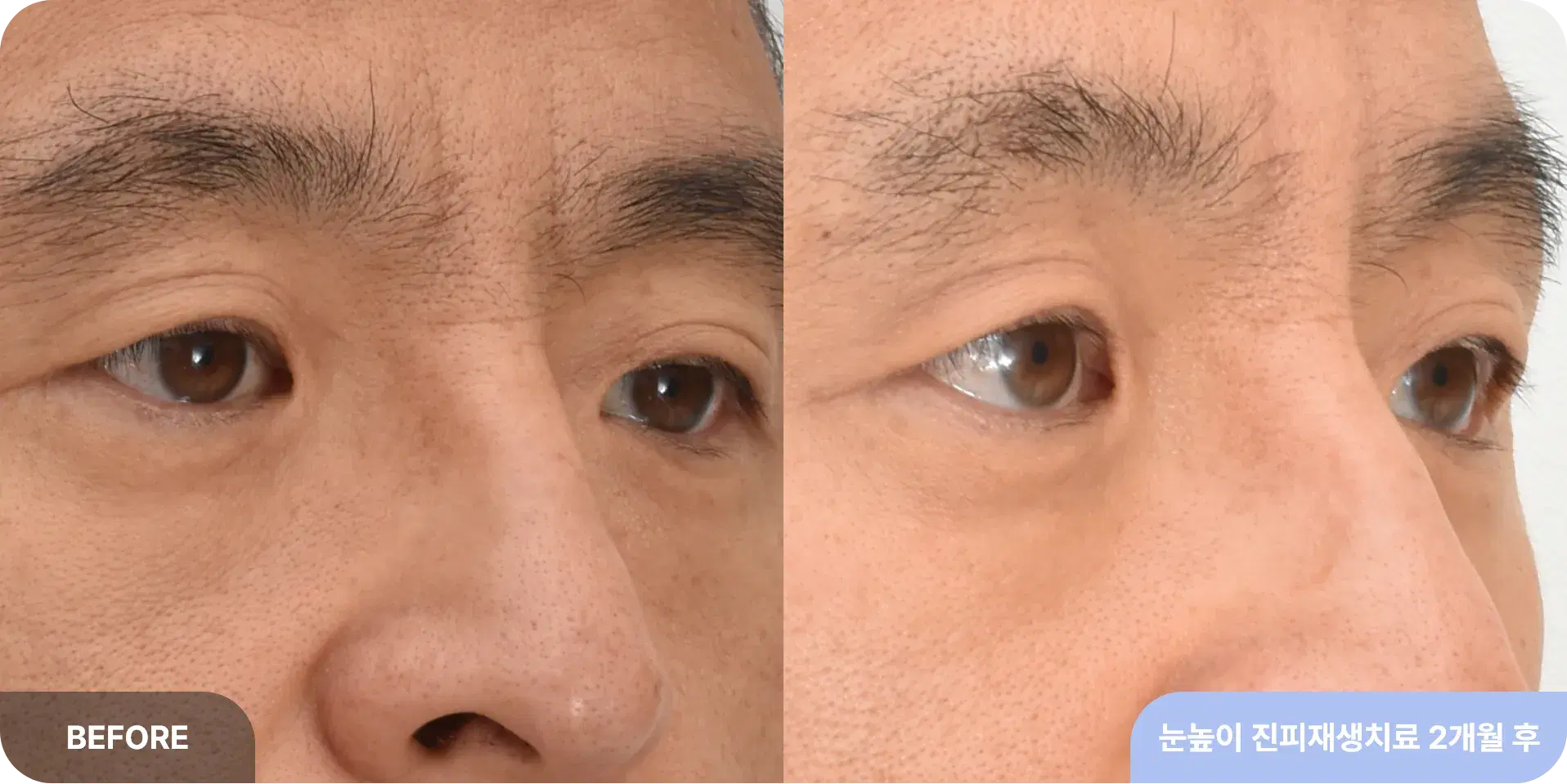 미간주름