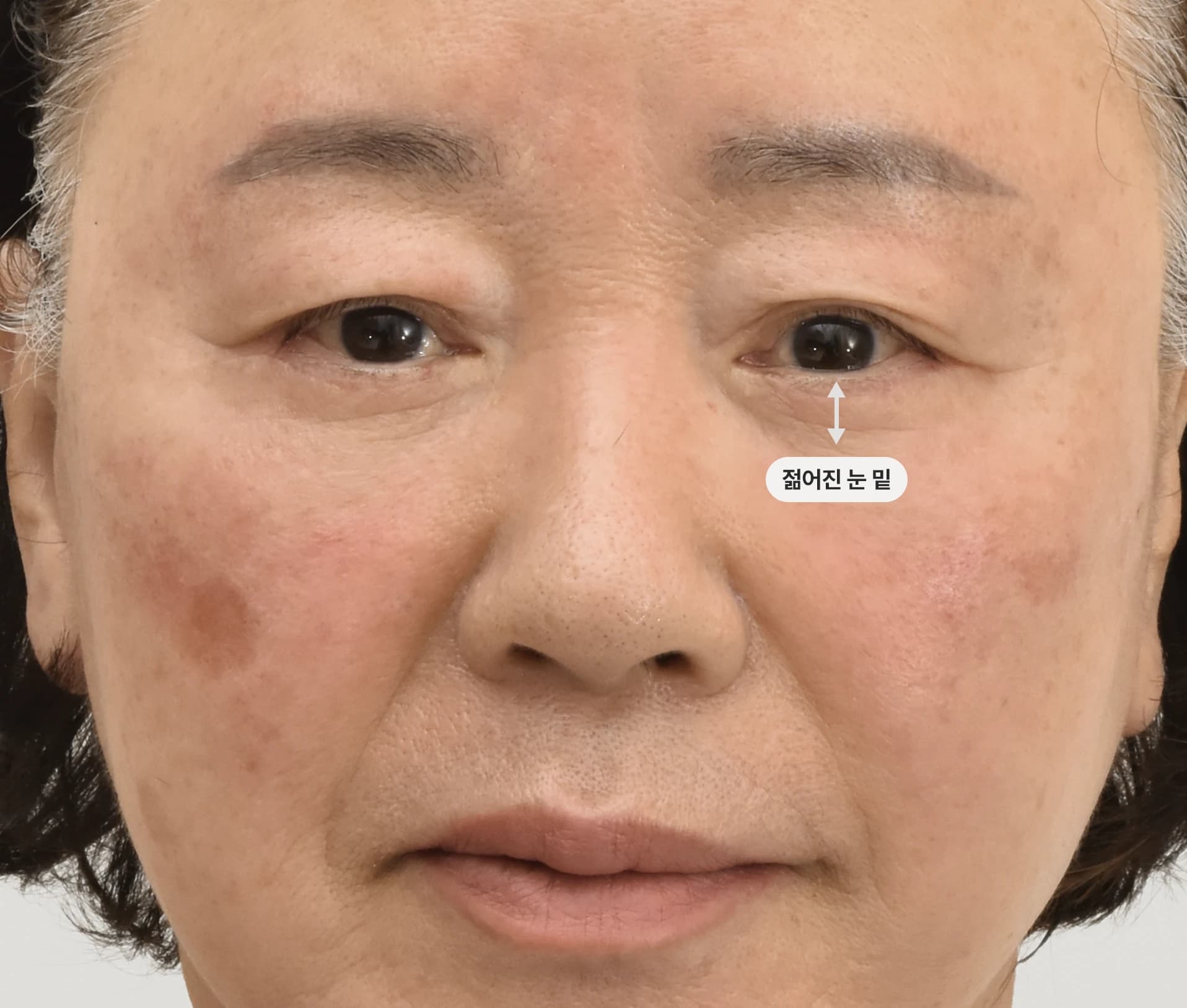 자연스럽게 얼굴 리프팅된 모습 - 안면거상술 전후 비교 사진