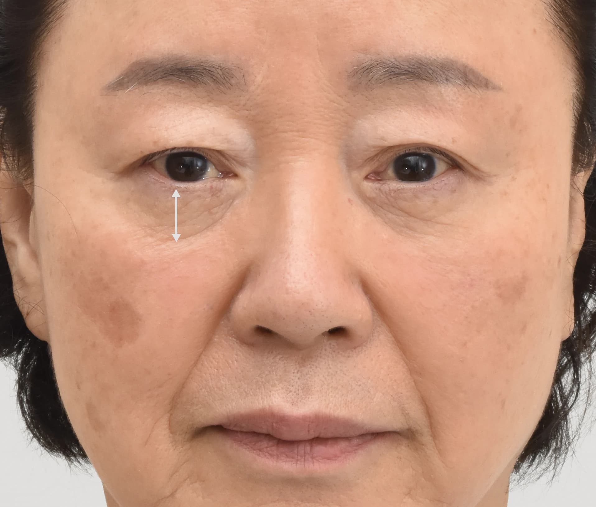 스마스 안면거상으로 팔자주름 및 입가 주름 개선 - 강남 눈높이 성형외과