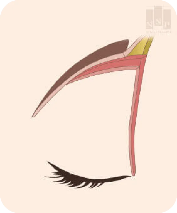 좋은 효과가 오래 가는 눈높이성형외과 눈썹거상 수술의 비결