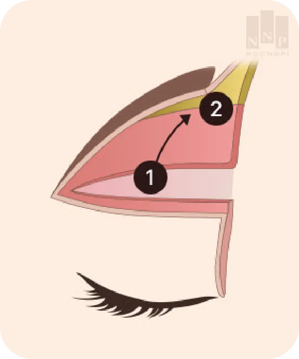 좋은 효과가 오래 가는 눈높이성형외과 눈썹거상 수술의 비결