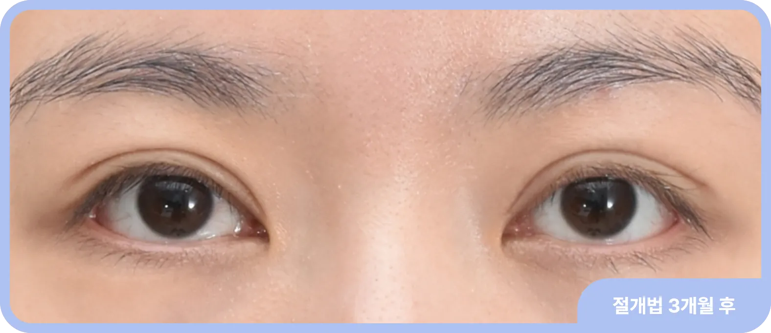 세미아웃 쌍꺼풀 수술 - 화려한 아웃라인 눈매