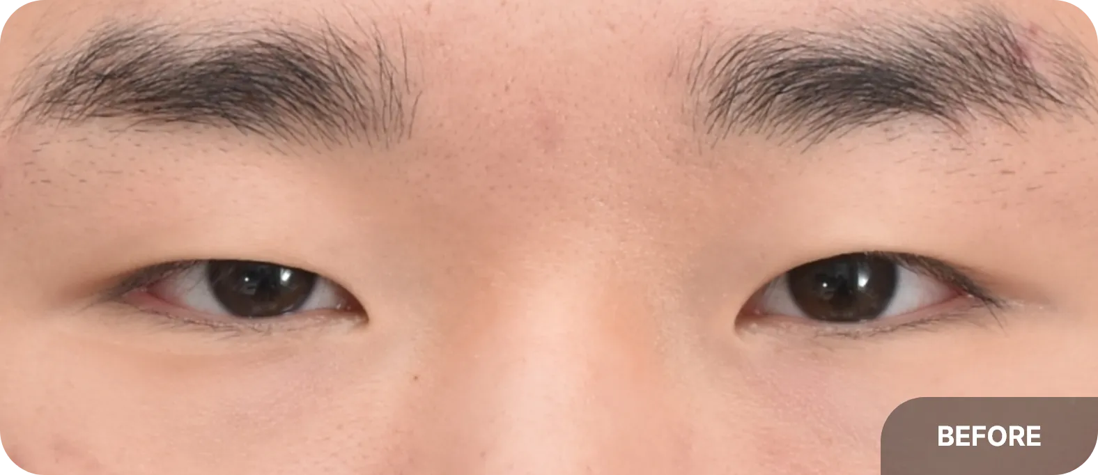 눈이 커지고 자연스러운 인상을 원하여 무쌍 눈매교정을 계획한 30대 남성