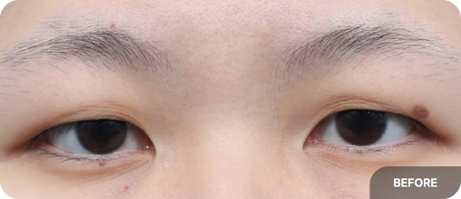 가성안검하수로 쌍꺼풀이 인상 개선에 도움되는 사례