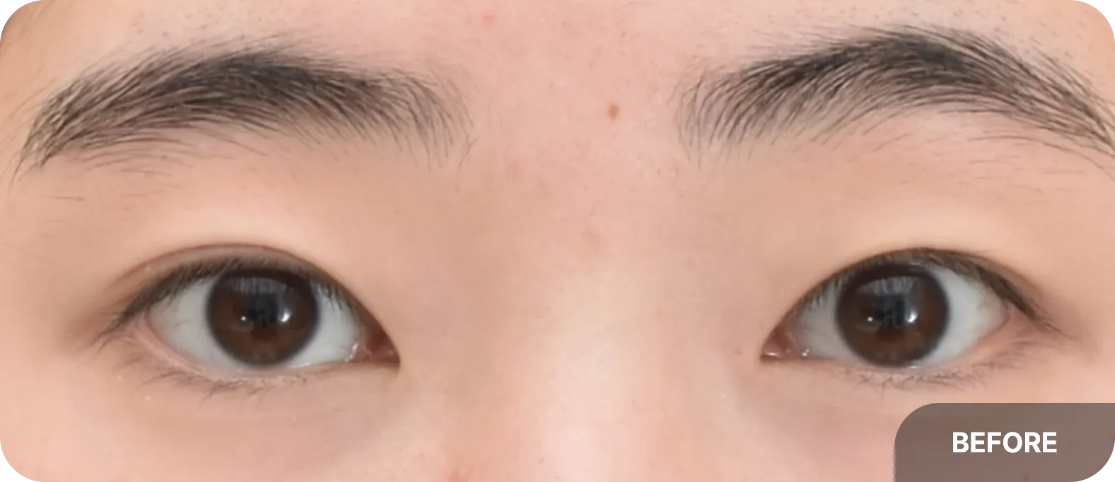 쌍꺼풀이 조금 더 커지고 싶어 매몰 인아웃라인을 결심한 사례