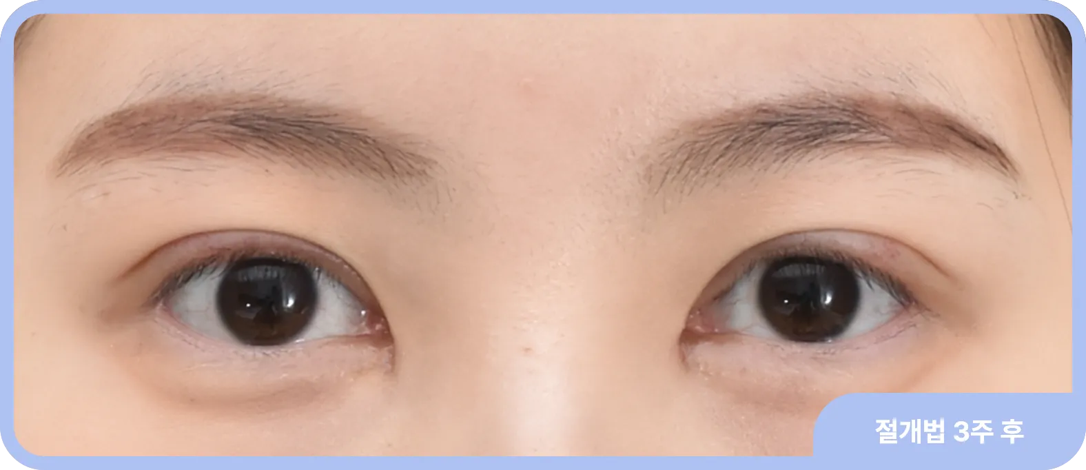 절개 쌍거풀 3주 후 자연스러운 모습