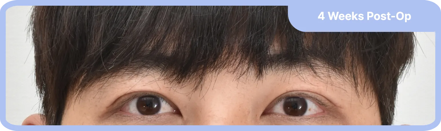 After ptosis surgery - natural eye appearance with comfortable and effortless eye opening