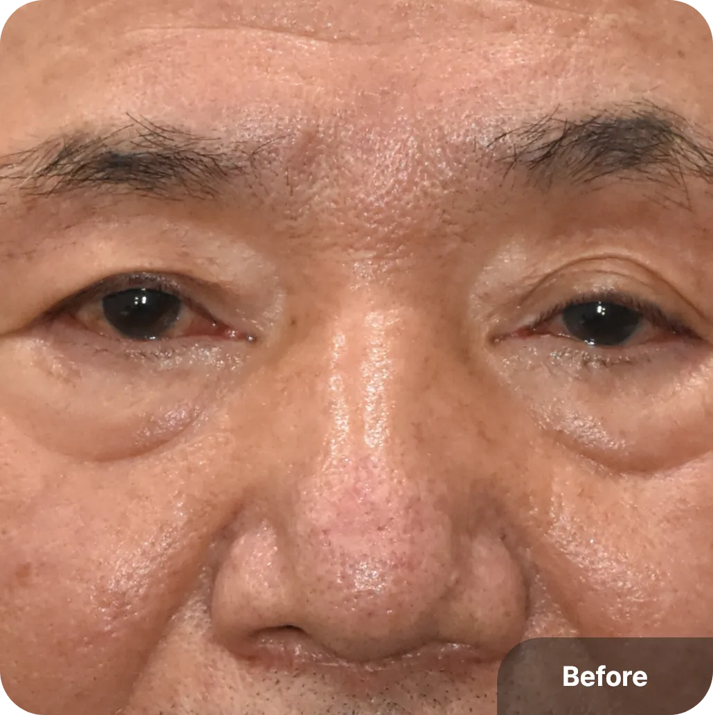 Aging lower lid - sagging skin, wrinkles, and puffiness around the eyes