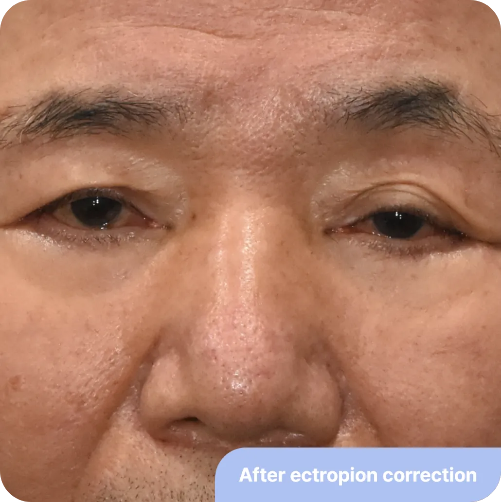 after ectropion correction