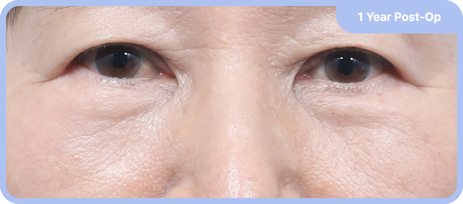 Post-operative lower blepharoplasty results - lifted and tightened lower eyelids