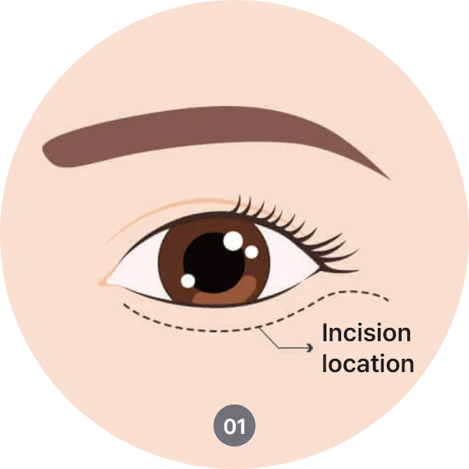 lower blepharoplasty procedure