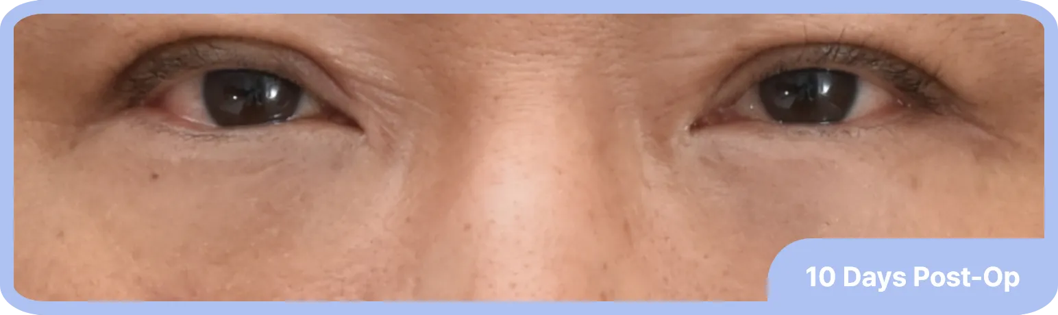 10 days after transconjunctival lower blepharoplasty surgery - rejuvenated eyes