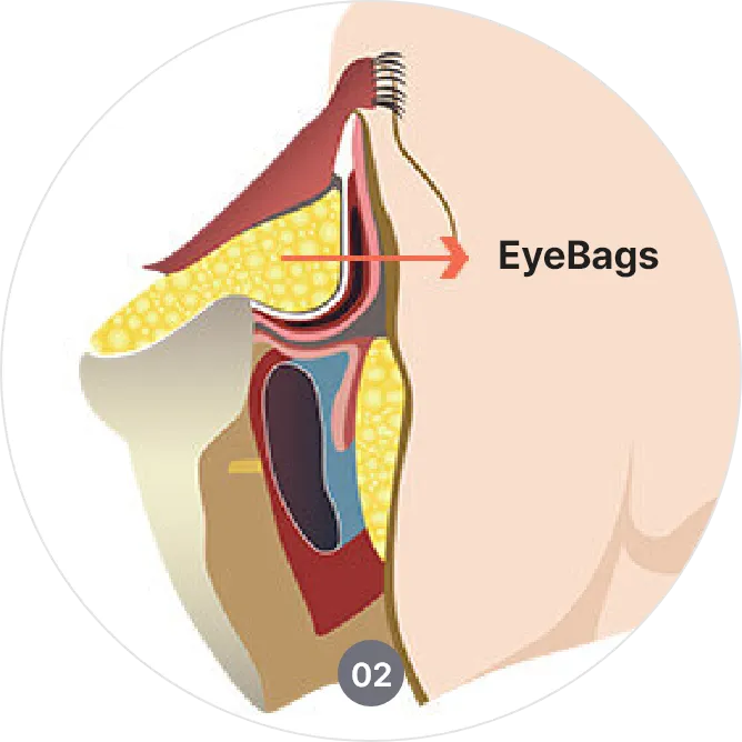 procedures of scar free lower blepharoplasty in korea