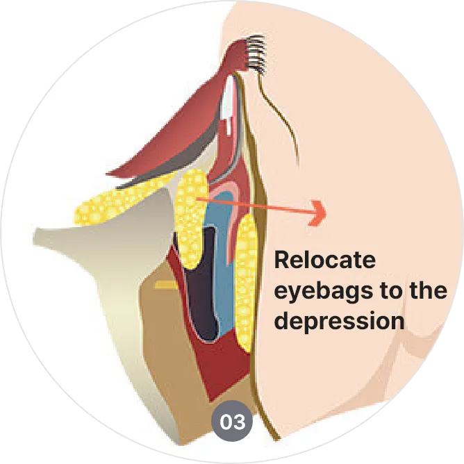 procedures of scar free lower blepharoplasty in korea
