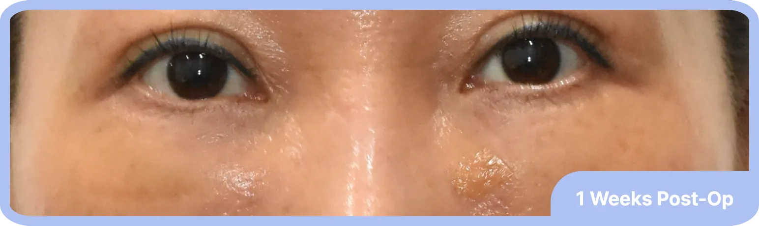 1 week after lower eyelid surgery - minimal swelling and quick recovery