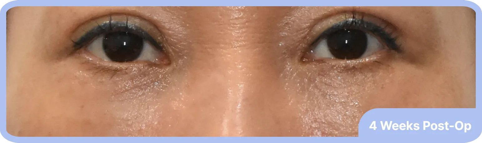 smooth lower lid after 4 weeks