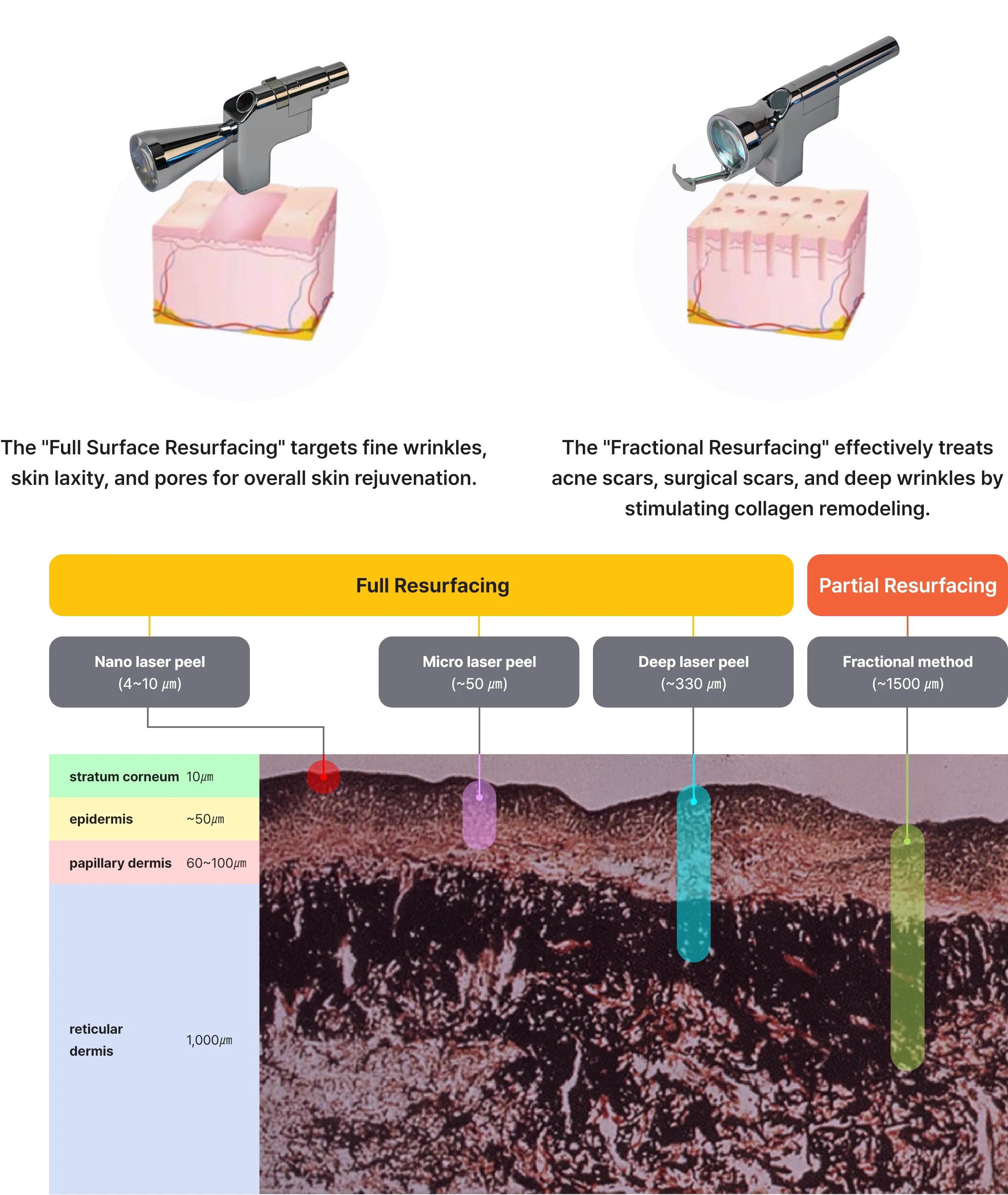 Sciton ZoomScan - full face facial resurfacing treatment/Sciton Profractional - fractional resurfacing laser/laser peeling with Sciton