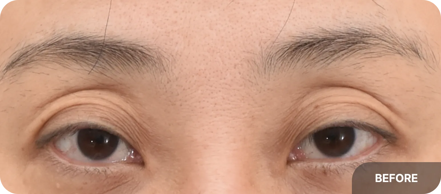 눈꼬리가 올라간 경우 뒤밑트임이 효과적