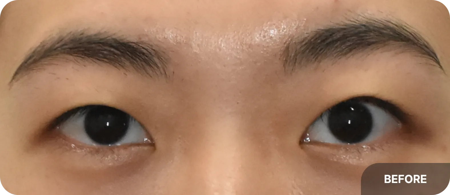 짝눈으로 눈매교정을 시행하기 전