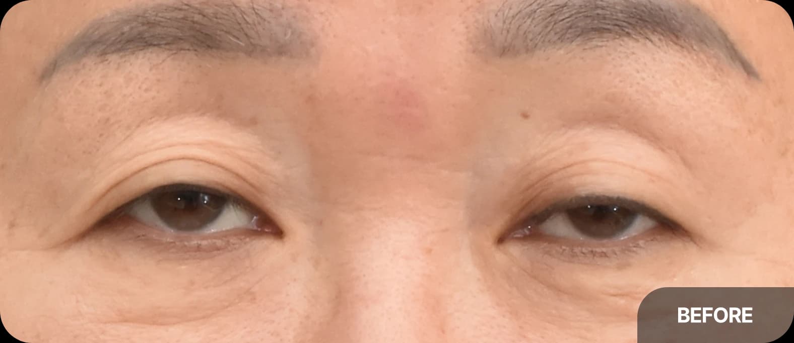 uneven eyes correction before