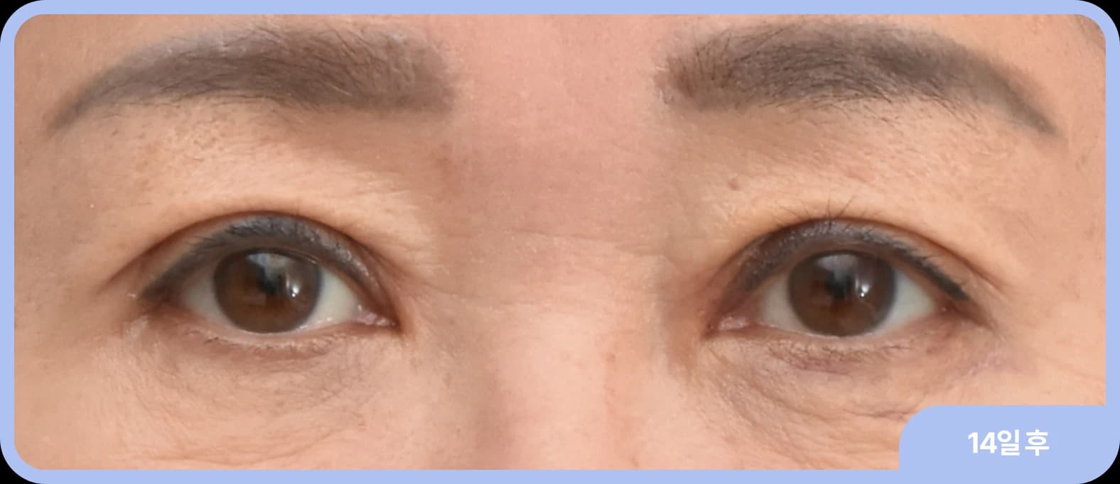 uneven eyes correction after