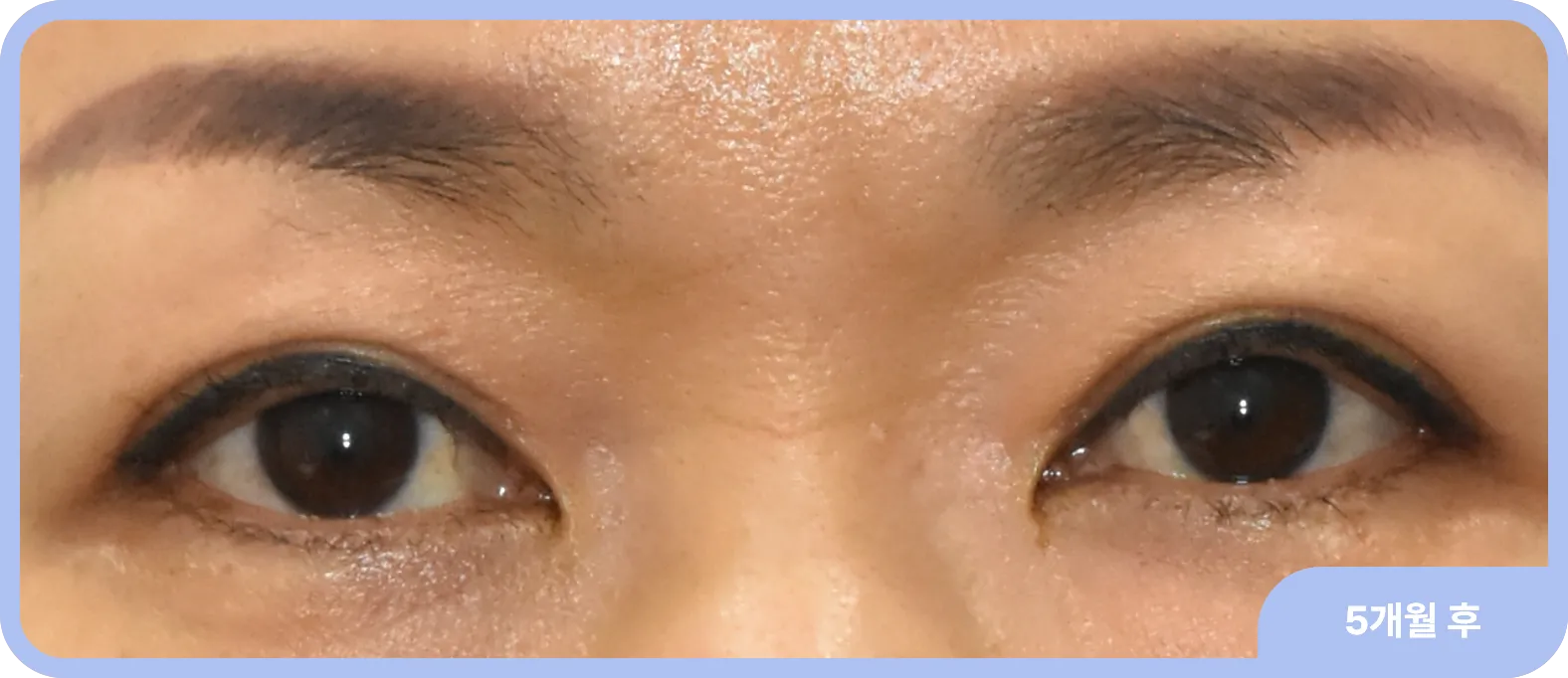 눈매교정으로 눈 비대칭을 교정 후 모습