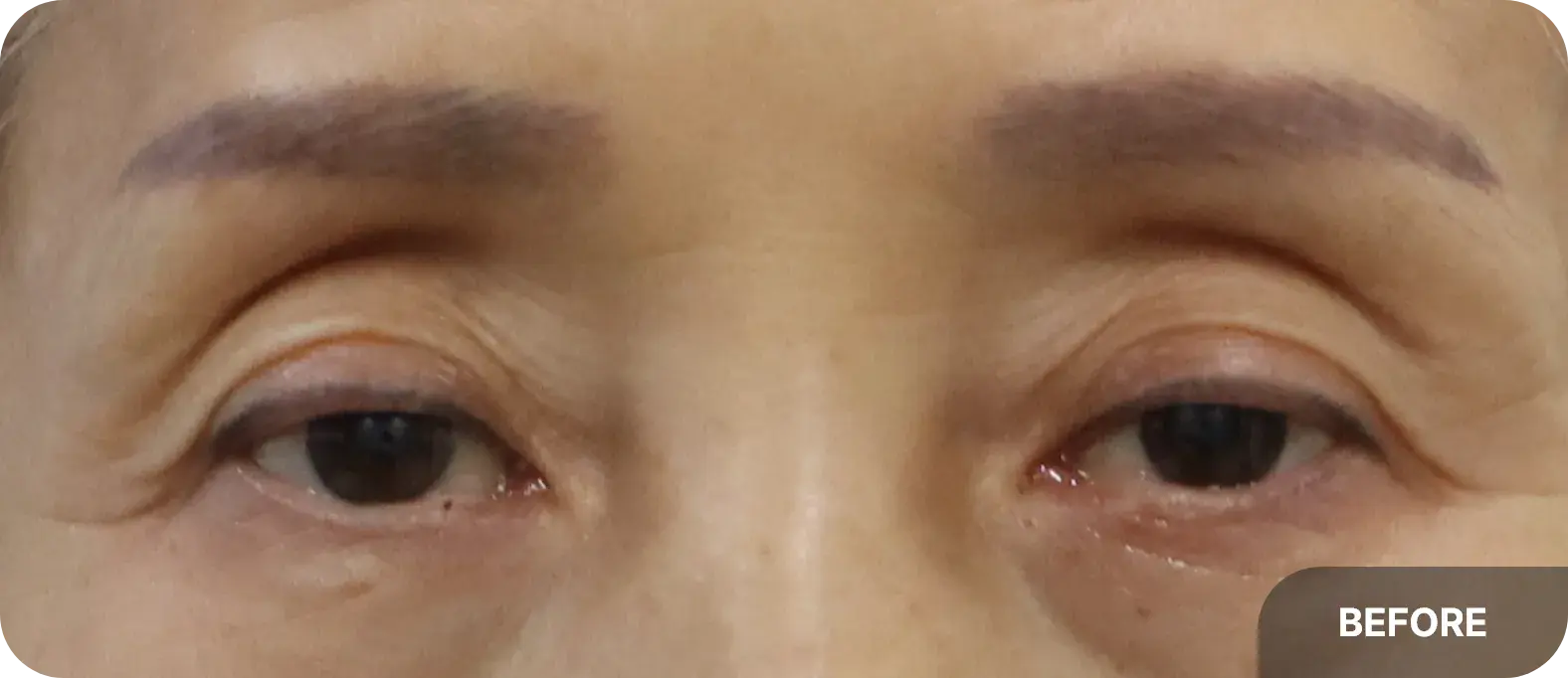 안검하수가 있는 중년 눈의 전형적인 특징
