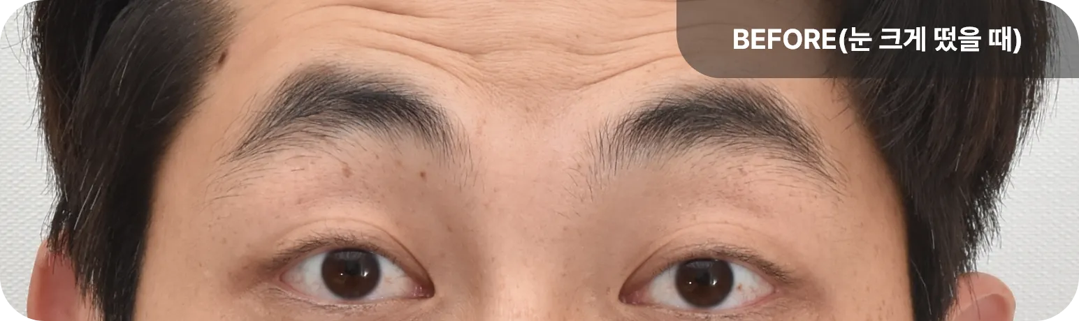 눈을 크게 떴을 때 모습 - 수술 전