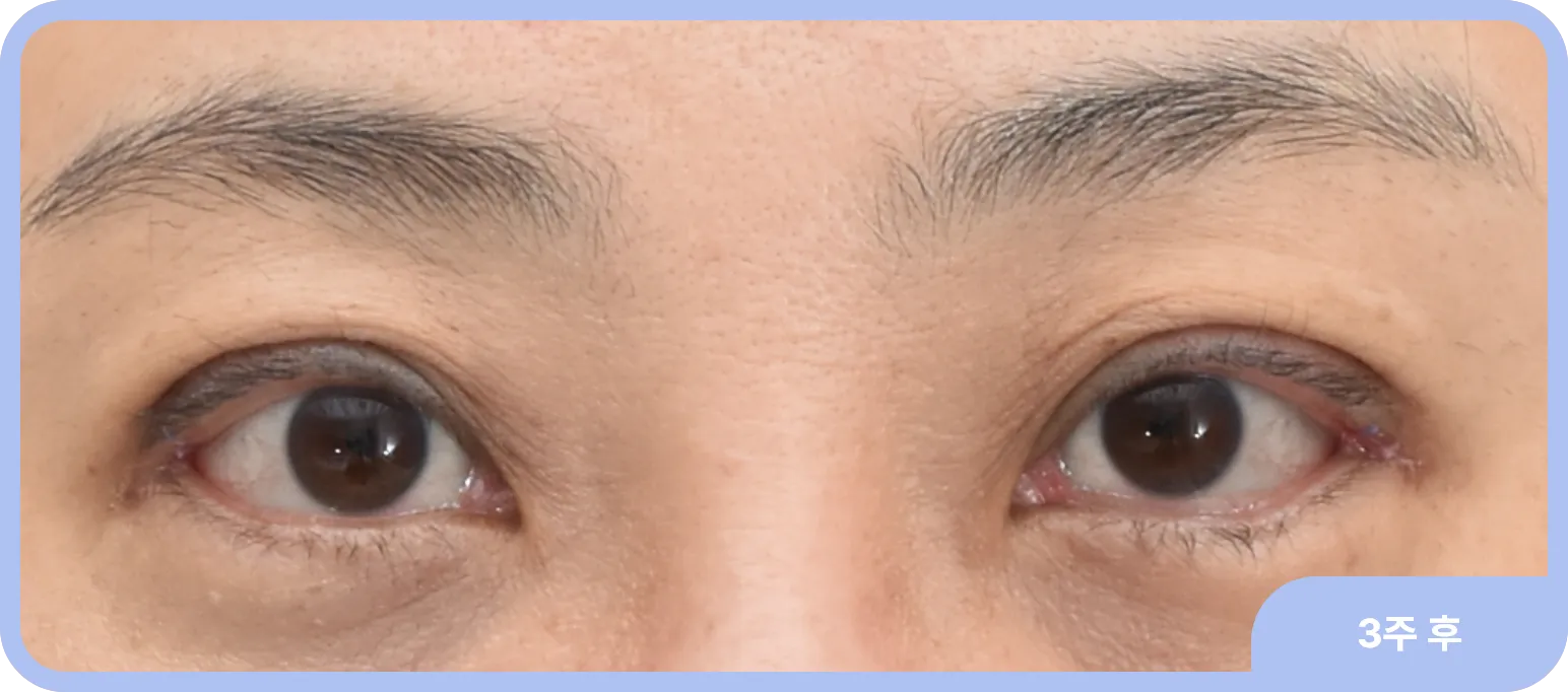 눈 귀 겹주름, 졸린 눈, 꺼진 눈을 안검하수 수술 하나로 모두 해결