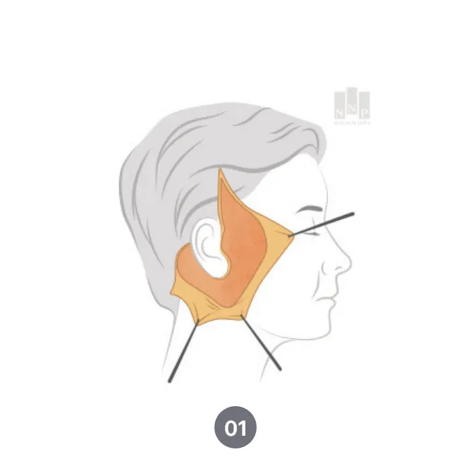 눈높이성형외과 안면거상술 방법 소개